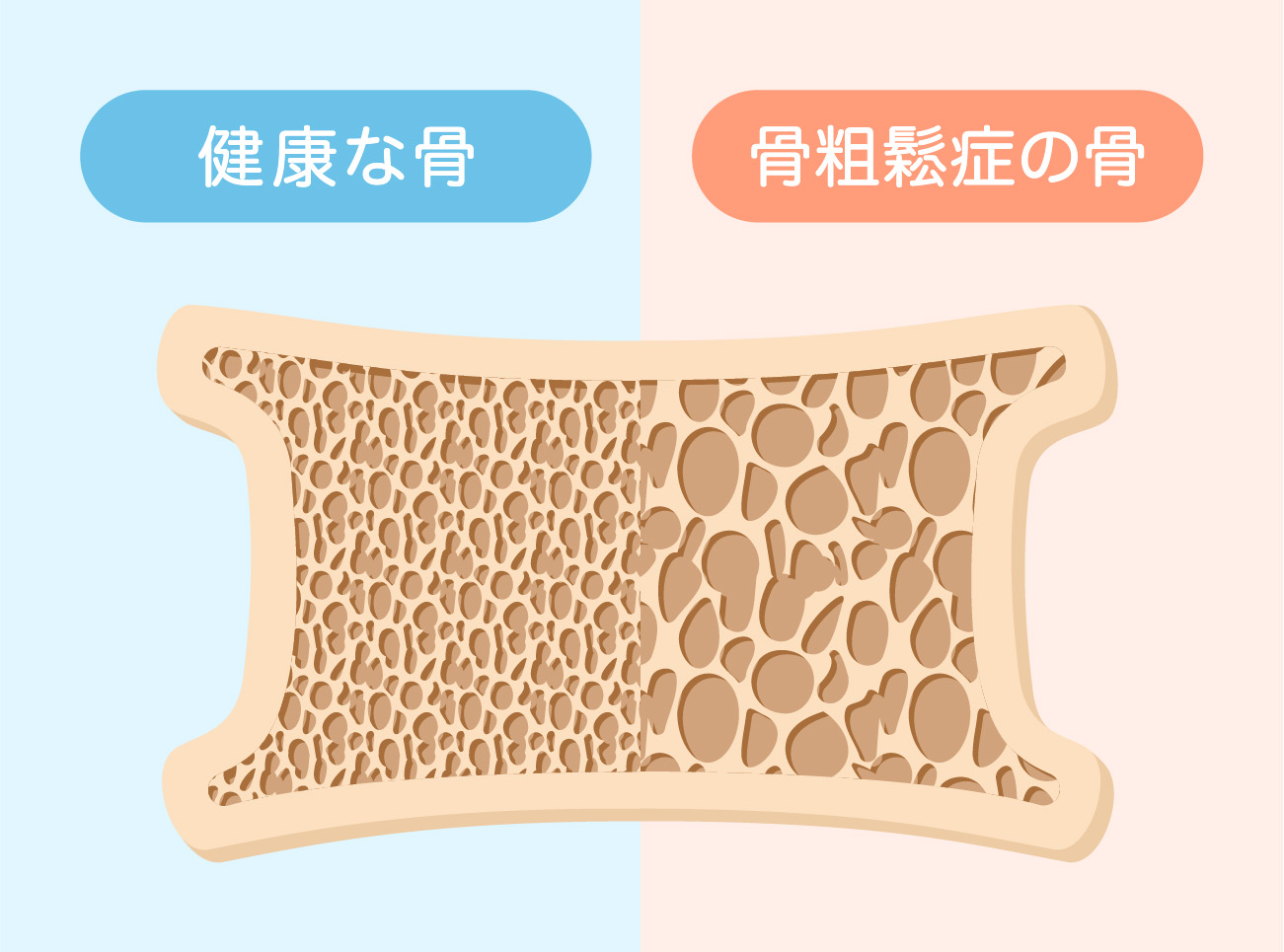 健康な骨と骨粗しょう症の骨